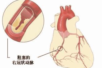 心绞痛的最新分型