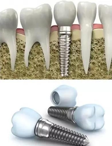 种植牙最新进展揭秘，小巷深处的隐秘宝藏探索